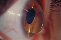 Прогнозирование эктазии роговицы после применения LASIK Прогнозирование