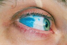 Заболевания склеры Заболевания