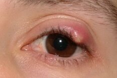 Воспалительные заболевания века. Абсцесс Воспалительные