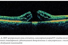 Макулярный разрыв Макулярный