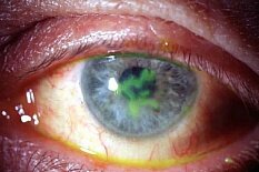 Вирусный кератит Вирусный