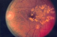 Патогенетические особенности различных стадий диабетической ретнопатии и методы лечения Патогенетические