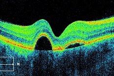 Центральная серозная хориоретинопатия-современные подходы к лечению Центральная