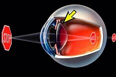 Пресбиопия Пресбиопия"