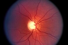 Атрофия зрительного нерва Атрофия