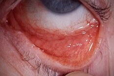 Хламидийный конъюнктивит Хламидийный